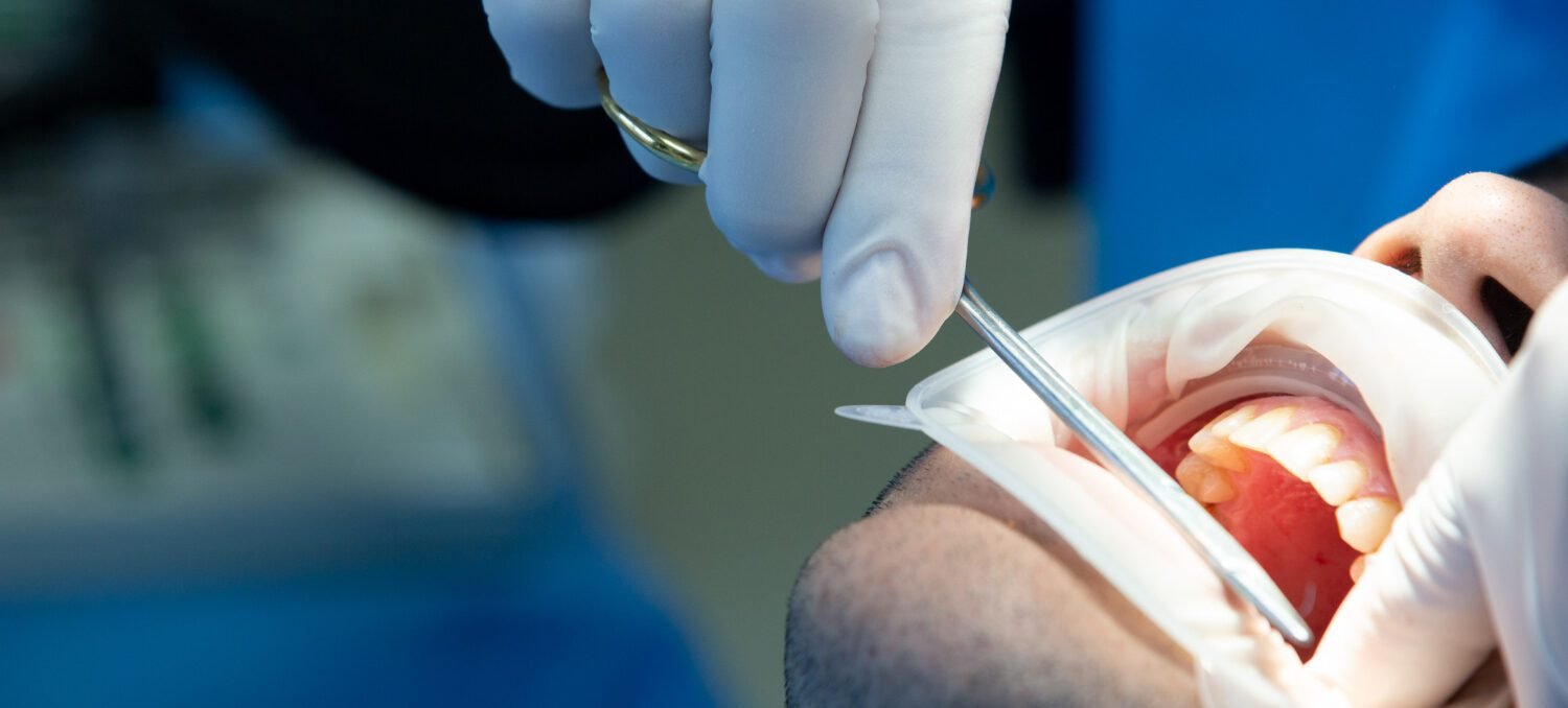 Periodontal Surgery Services at Smile Zone of Irving