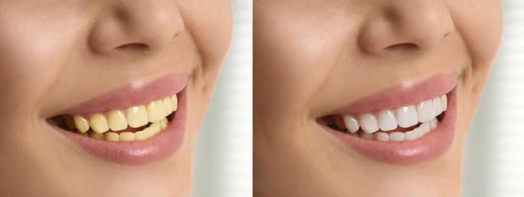 Before/after showing tooth-colored composite filling blending with natural tooth