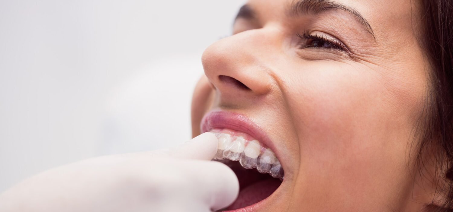 Invisalign Services at Smile Zone