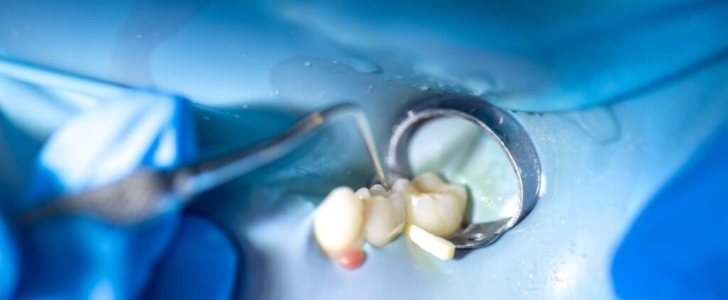 Custom porcelain only covering damaged tooth cusps.