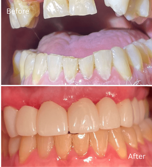Cosmetic case Anterior bridges case