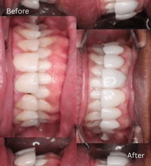 Cosmetic case anterior crowns