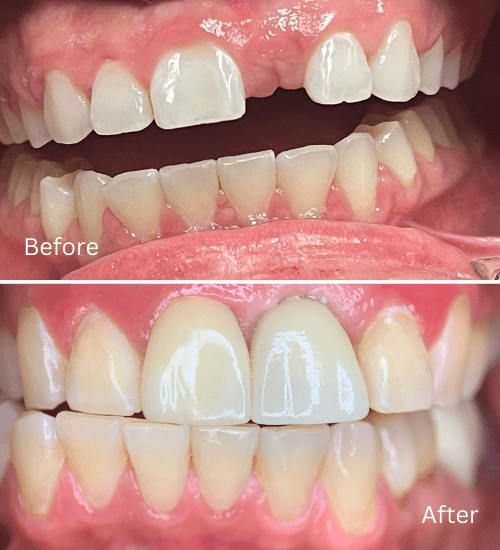 Cosmetic case anterior implant.