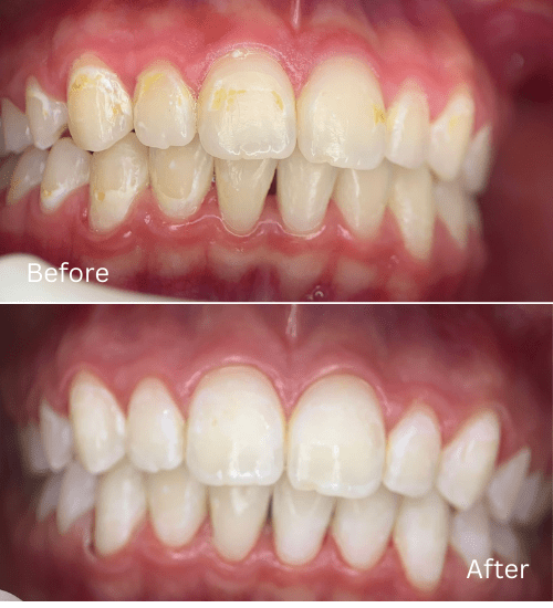 Cosmetic case anterior remineralization after bracers.