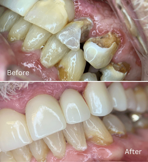 Cosmetic case. Anterior composite veneers