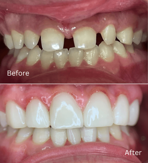 Cosmetic case. Anterior prepless veneers and gingivectomy