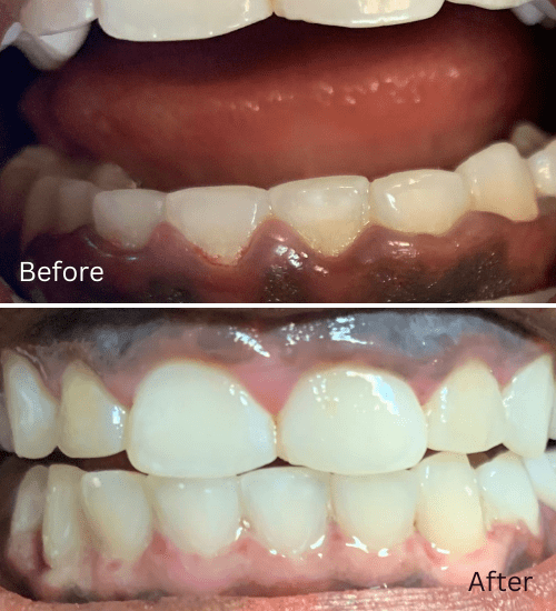 Gingivectomy and gum depigmentation
